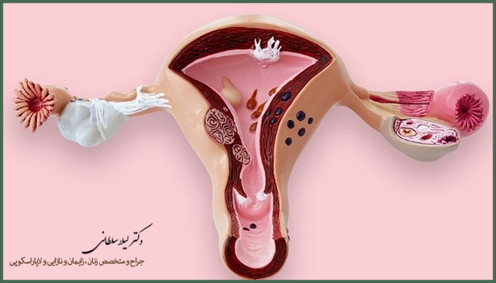 علت تنبلی تخمدان