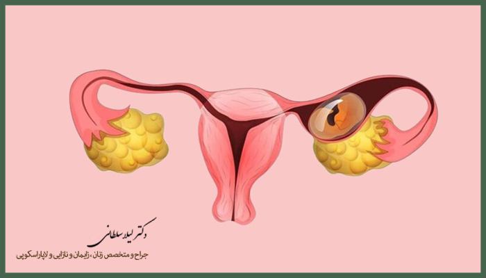 تشخیص بارداری خارج رحم