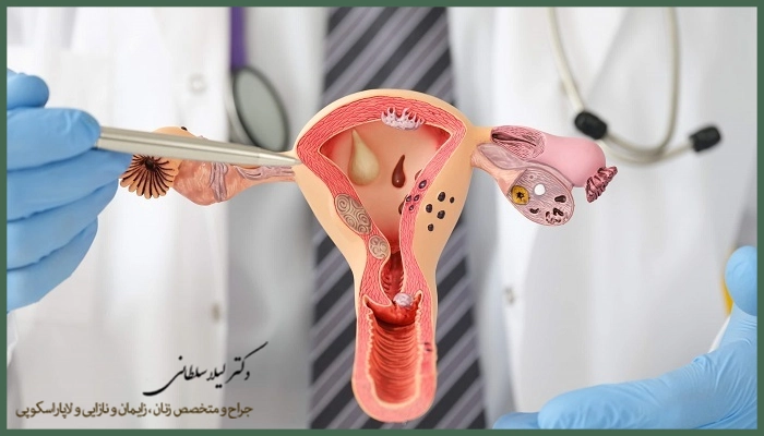 علائم کیست تخمدان در پریودی چیست؟