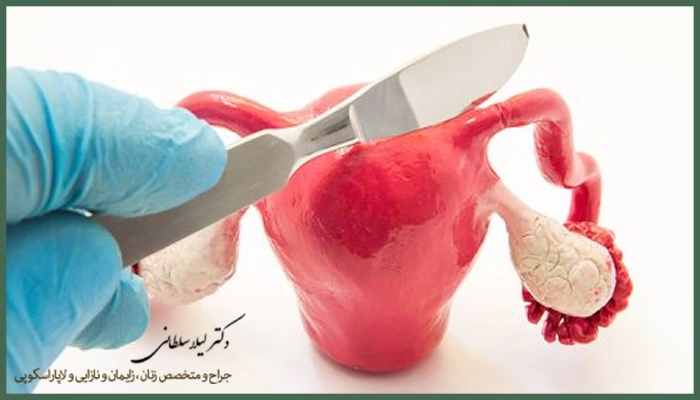 جراحی برداشتن تخمدان چگونه انجام می‌شود؟