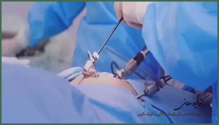 لاپاراسکوپی آندومتریوز برای چه کسانی مناسب است؟